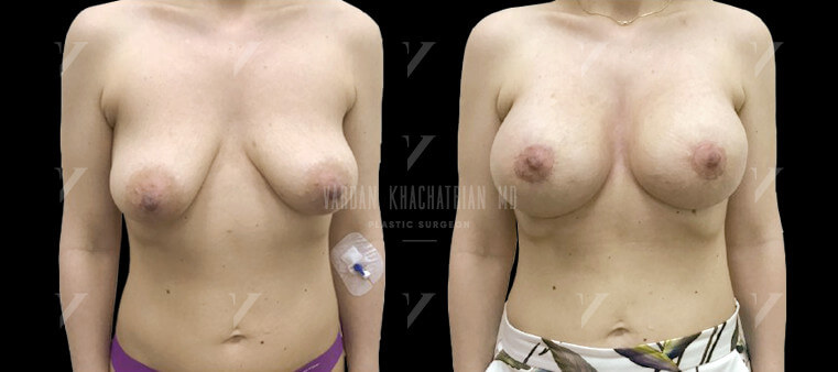 Подтяжка и увеличение груди, коррекция тубулярности молочных желез