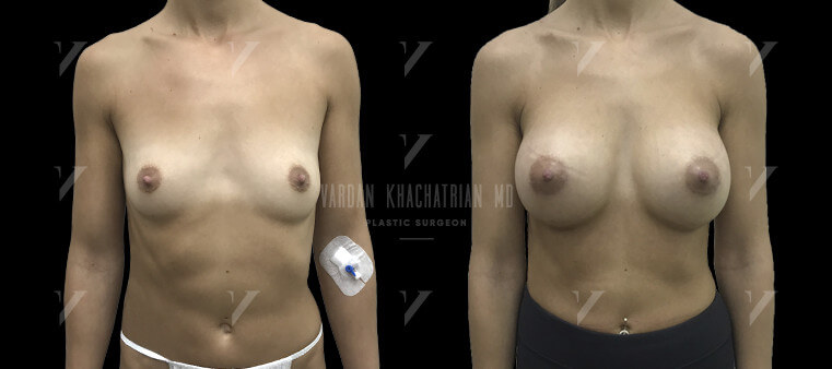 Увеличение груди Первичная маммопластика